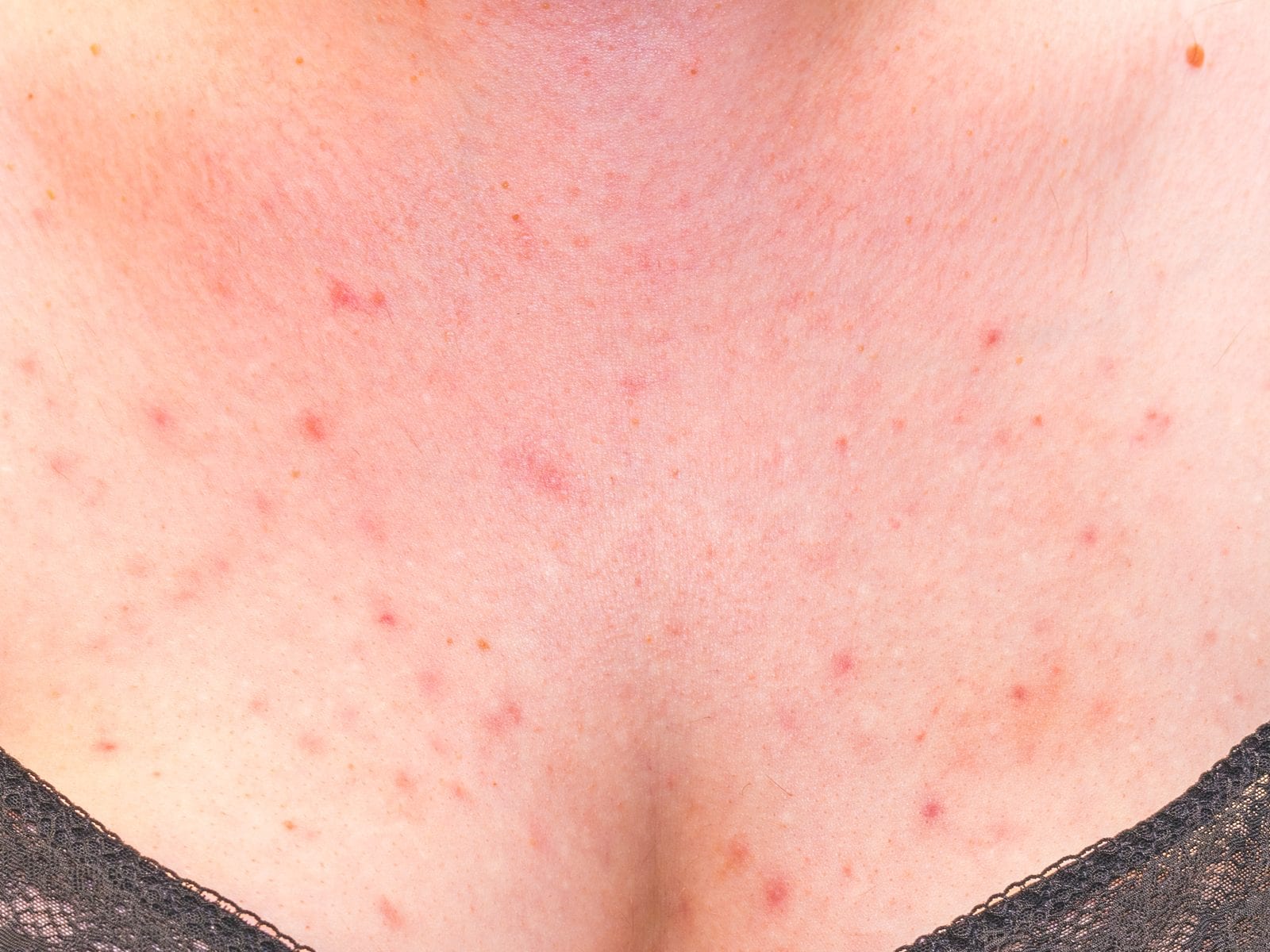 What leads to Breast Acne? Check Out the 8 Most Prominent Factors - News18
