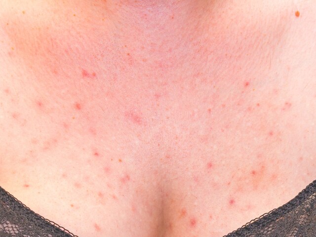 Eight reasons why some people get breast acne, and what to do about it