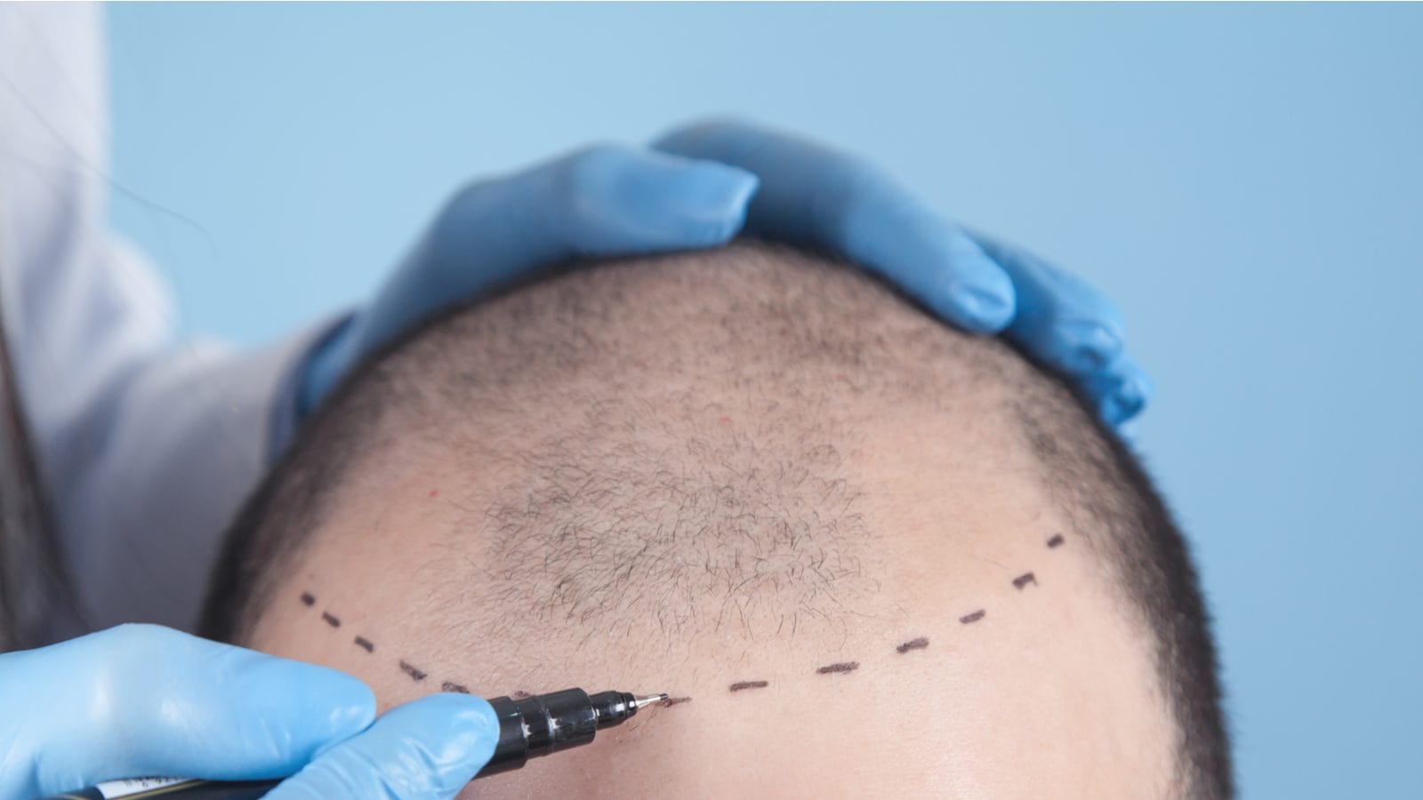 Hair Transplantation All you Need to Know