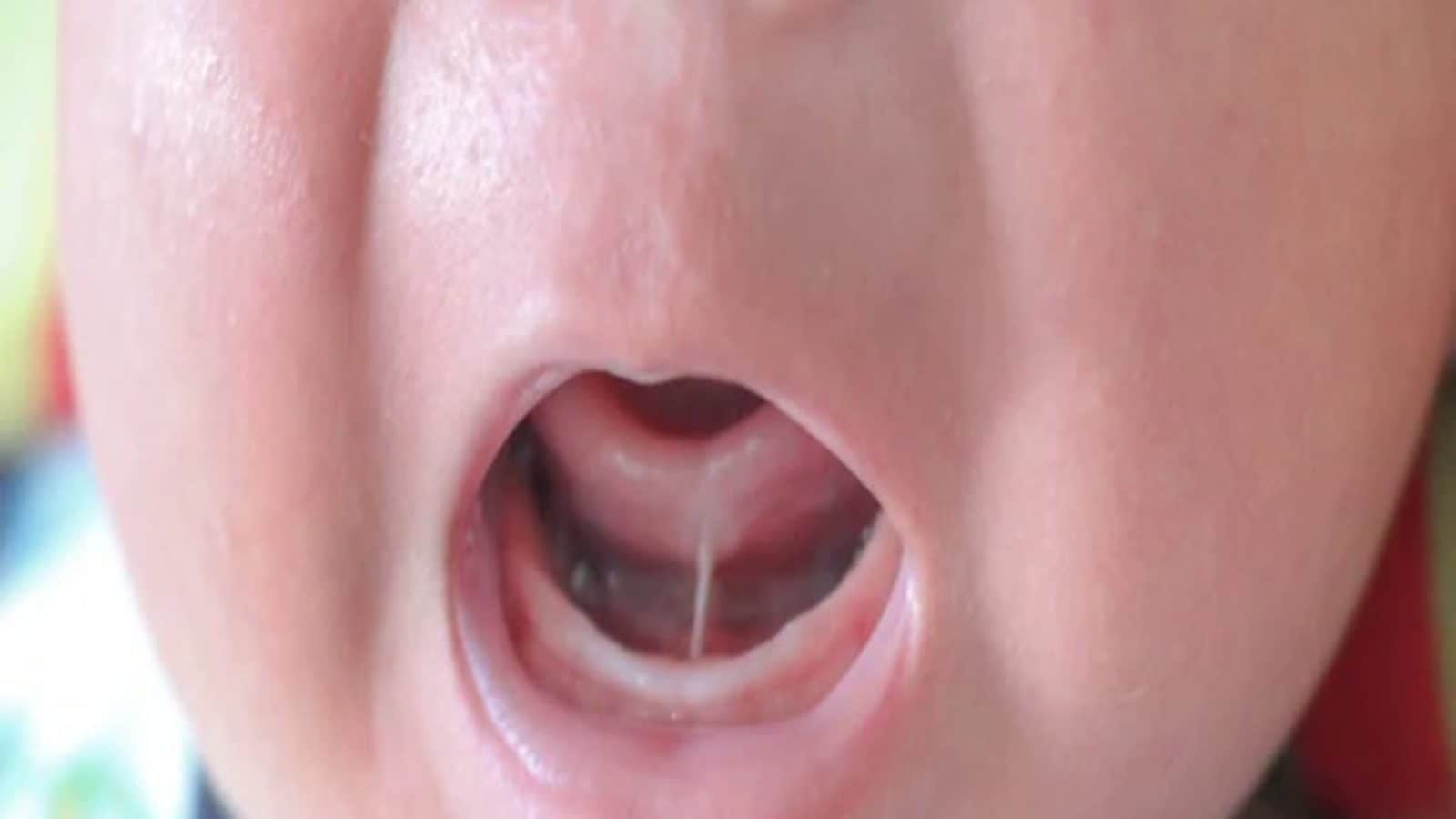 what-is-tongue-tie-among-children-symptoms-and-other-things-you-need