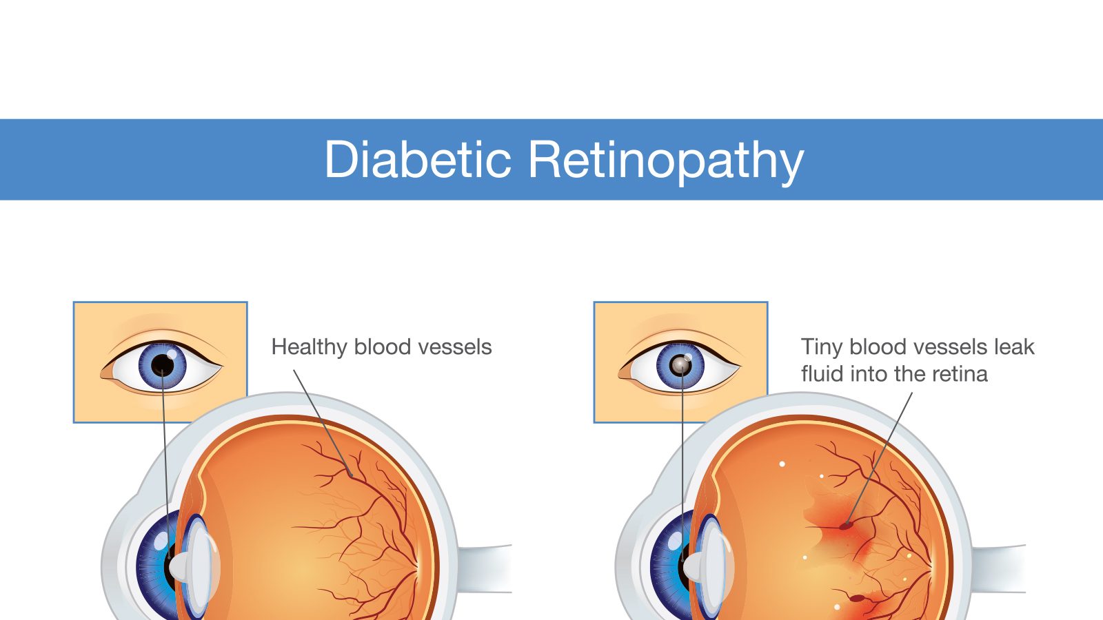 Komplikasi mata yang harus Anda ketahui, jika Anda hidup dengan diabetes.