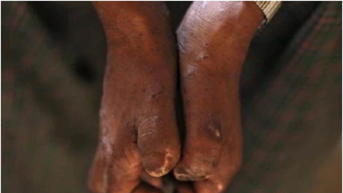 World Leprosy Day 2022: Has Leprosy Been Eradicated Around The World?