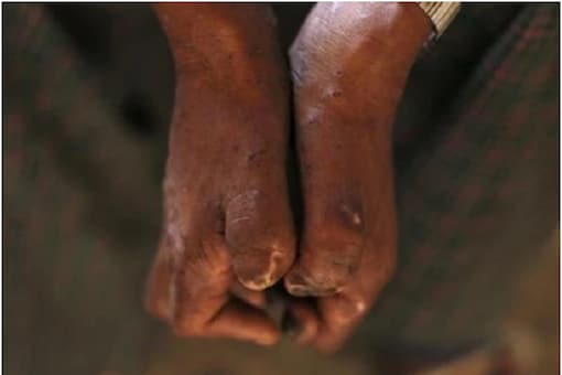 As per the WHO, about 1,27,500 new leprosy cases were recorded from 139 countries in 2020. (File pic)

