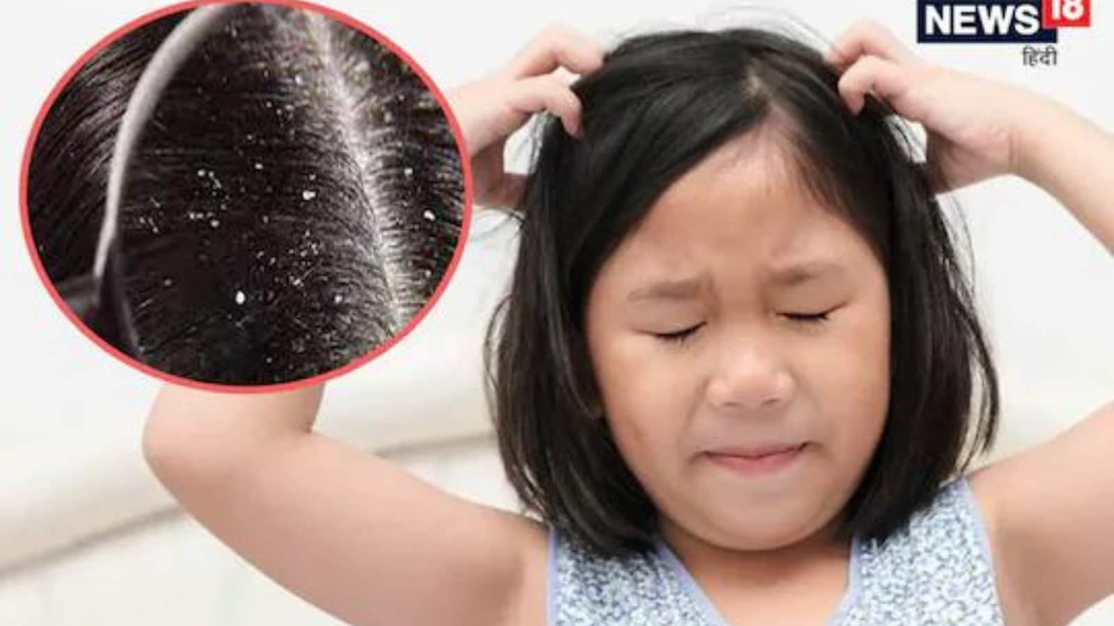 How to Get Rid of Dandruff From Hair?