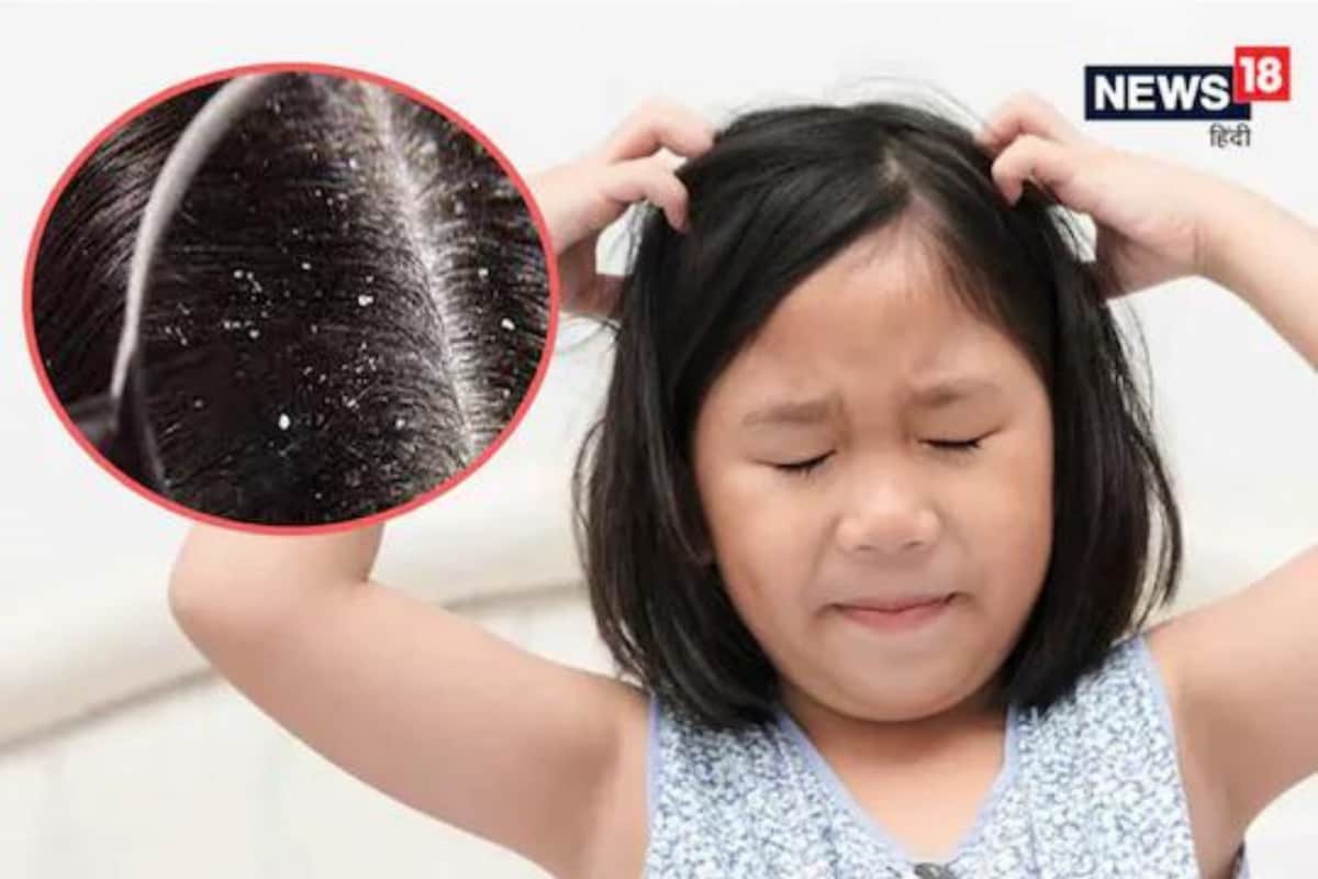 How To Remove Dandruff Quickly 6 Pro Tips For Hair Care