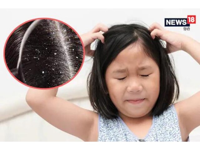 Home remedies for store dandruff in babies