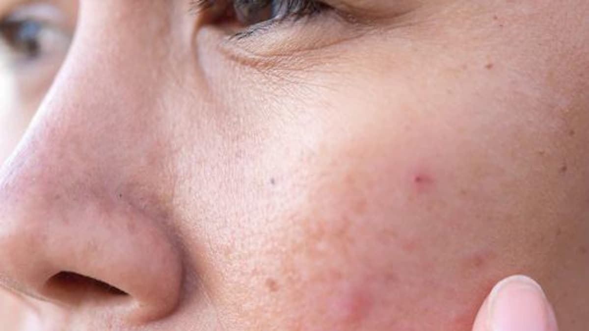 Dark Spots? Try These Home Remedies to Get Flawless Skin