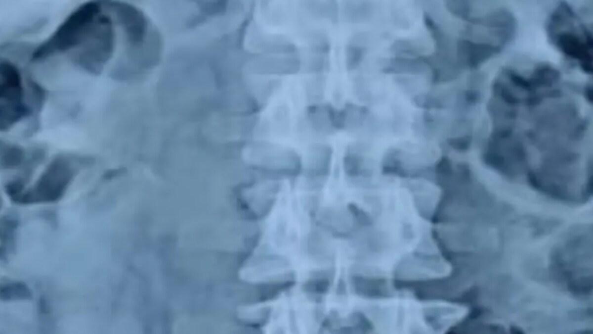 This Woman's UTI Turned Out to Be a Glass Tumbler Lodged for Last 4