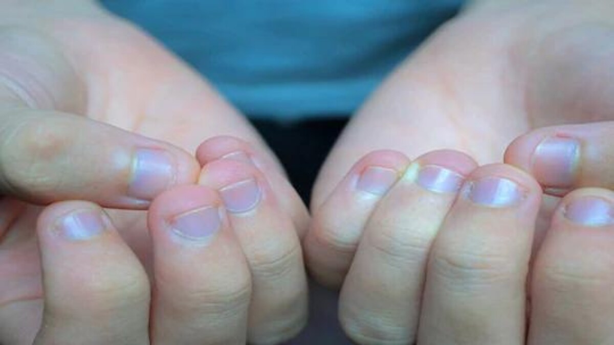 Skincare Tips Get Rid of Peeling Cuticles With These Easy Home