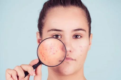 Dermatologist Explains What Causes Acne, and How We Address The Issue Dermatologist Explains What Causes Acne, and How We Address The Issue