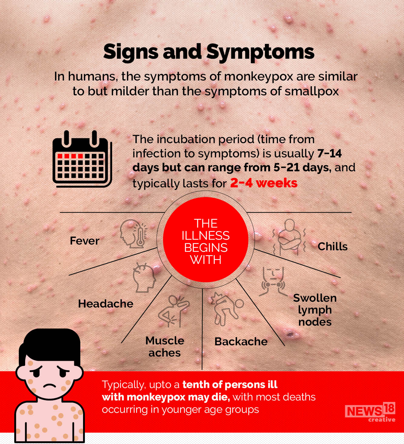 As Monkeypox Detected in North America, Europe; Here's All You Need to ...