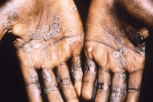 Monkeypox: Outbreak Continues In North America, Europe As US, Canada Report First Cases | Top Points