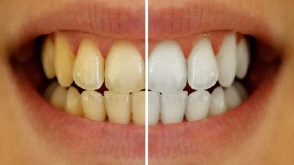 Ways to Care for Your Teeth After a Whitening Treatment