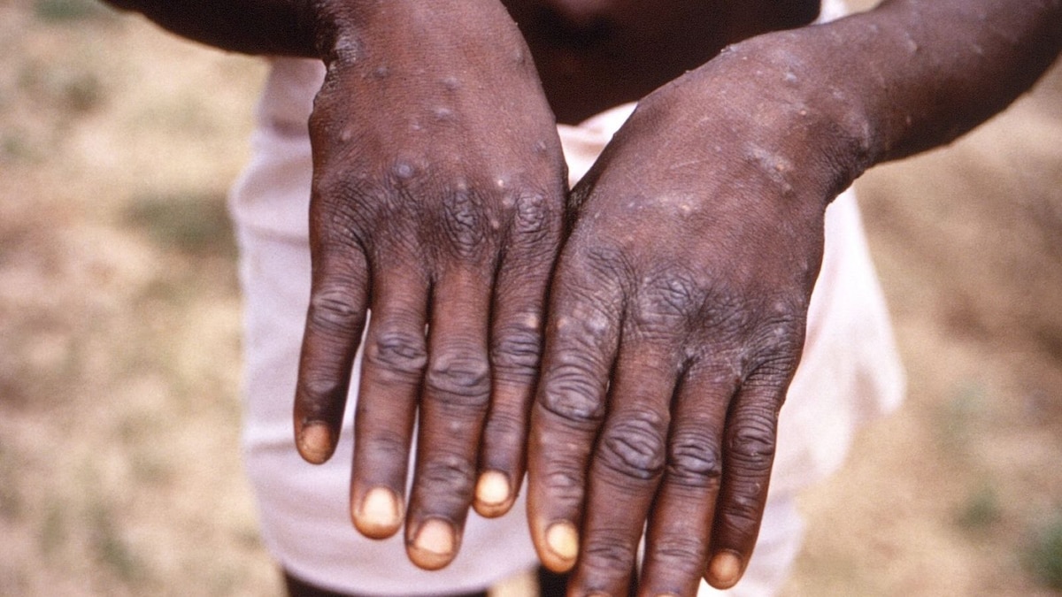 WHO Declares Monkeypox A Global Health Emergency Amid Surge in Cases