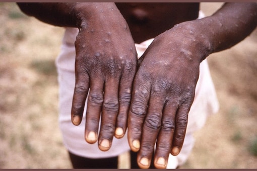 An image created during an investigation into an outbreak of monkeypox, which took place in the Democratic Republic of the Congo (DRC), 1996 to 1997. Via Reuters