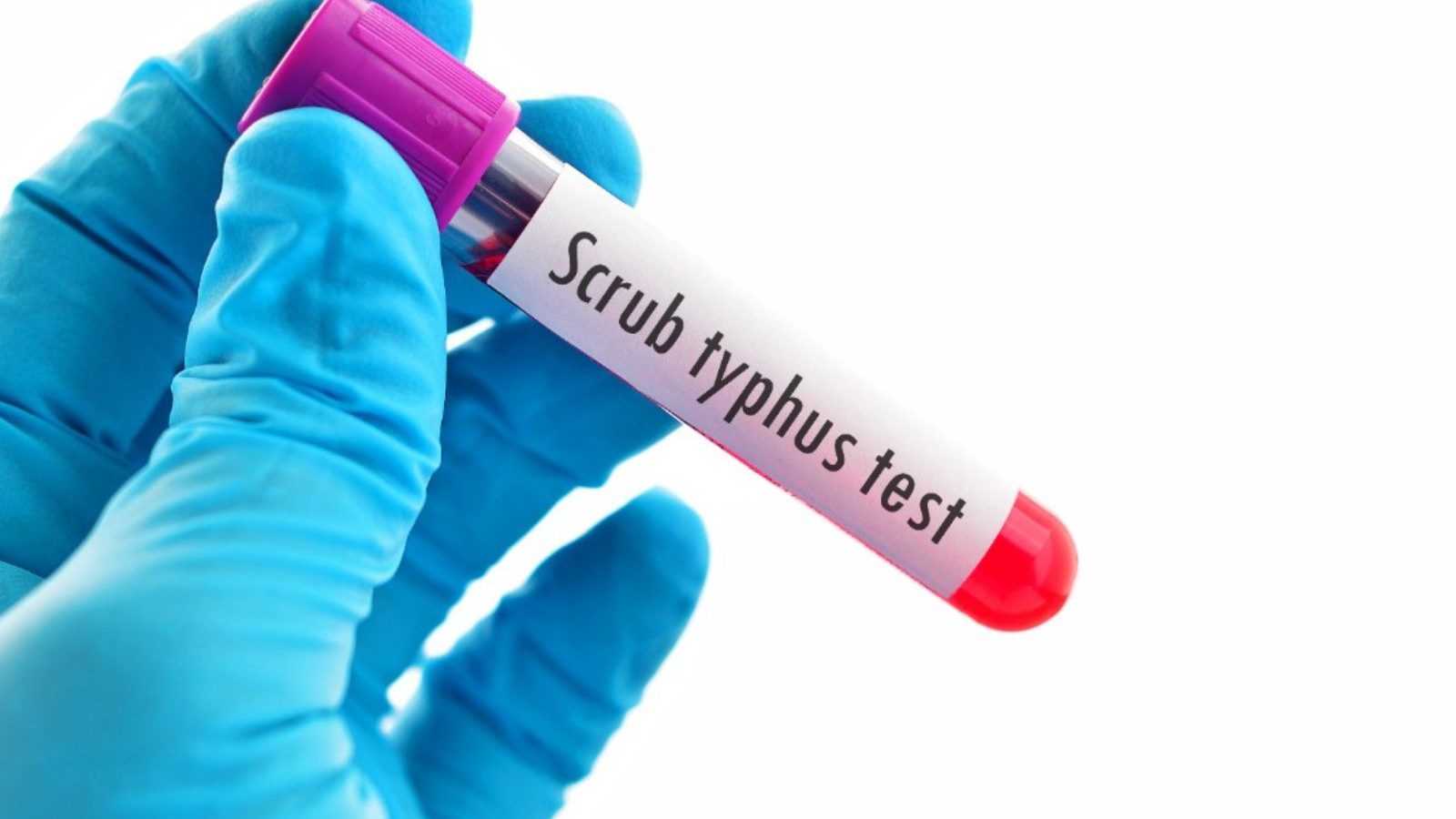 kerala-reports-second-death-due-to-scrub-typhus-all-about-the-disease