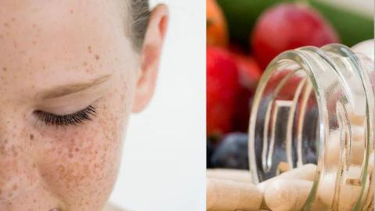 Three Vitamins You Must Ensure in Your Body to Cure And Prevent Freckles on Skin