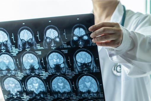 A brain tumour occurs in brain cells that multiply abnormally and in an uncontrolled way. (Representative image: Shutterstock) 