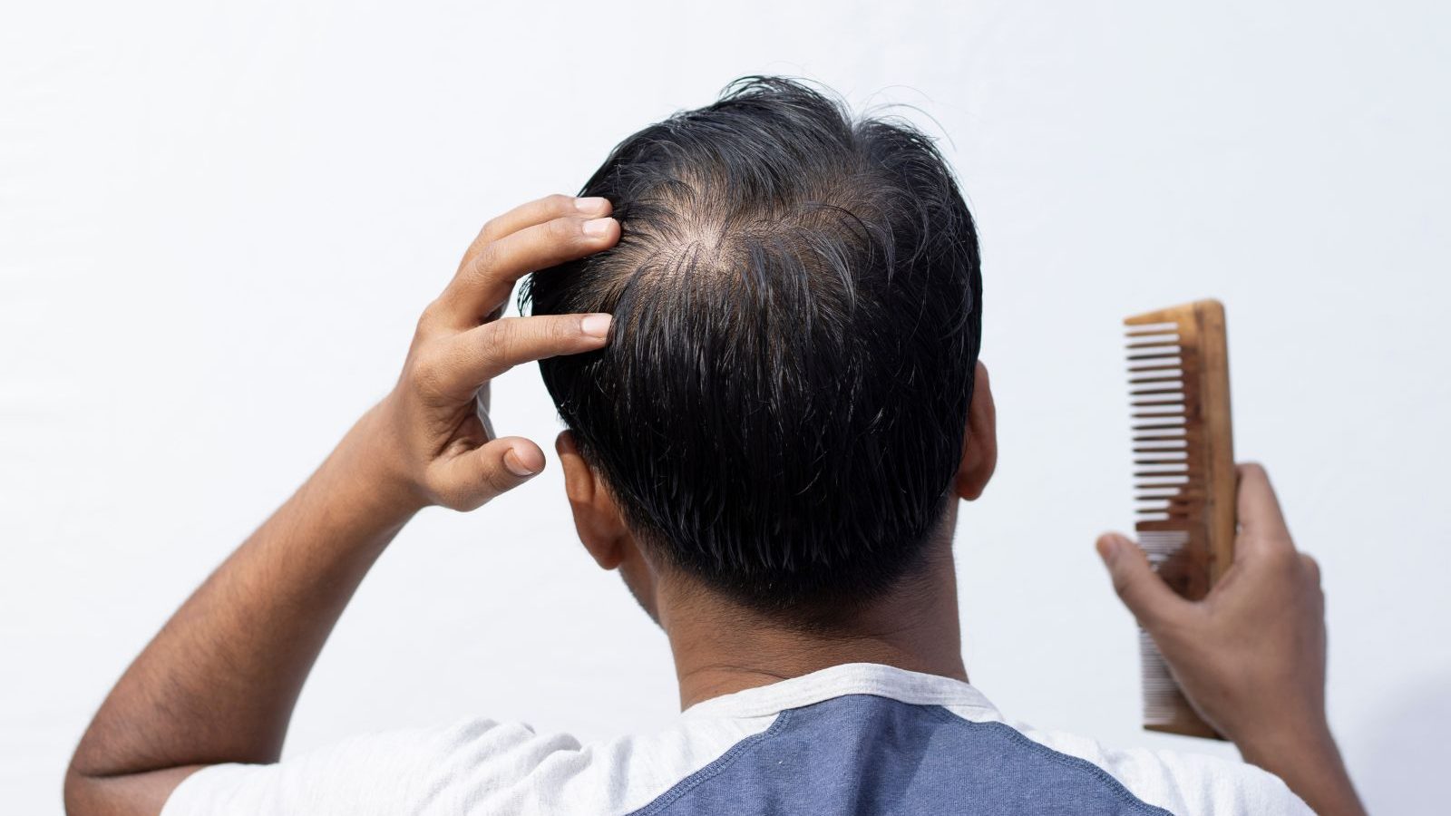 Reasons For Hair Loss In Men  Blog