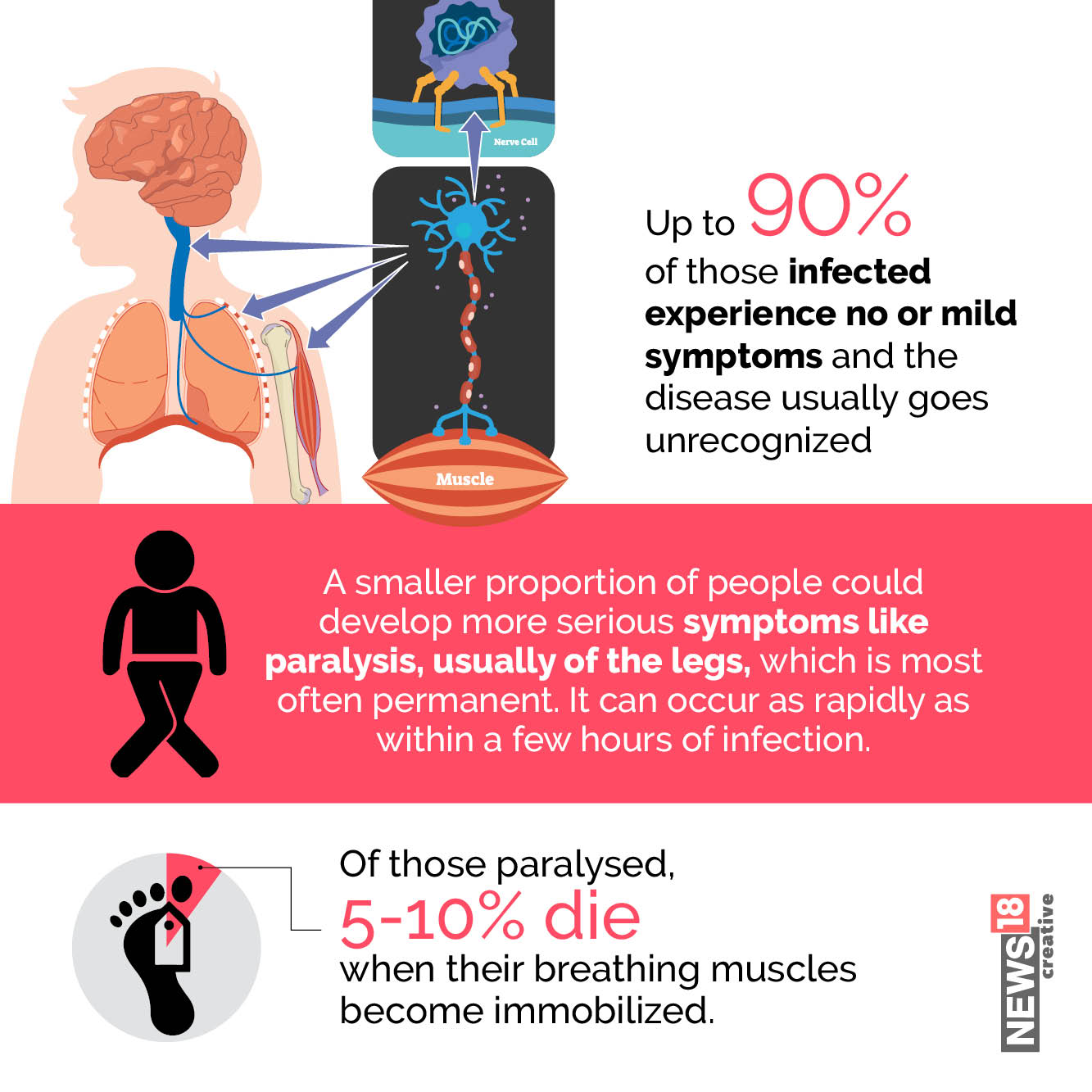 Is Polio Making A Comeback? Know About Its Symptoms, Treatment And ...