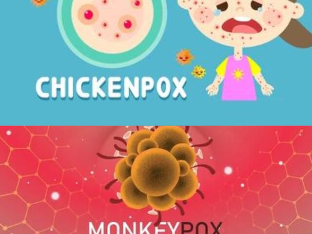 Monkeypox Vs Chickenpox: Know How You Can Differentiate The Symptoms ...
