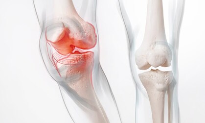 What Are the Risks of Knee Replacement Surgery?