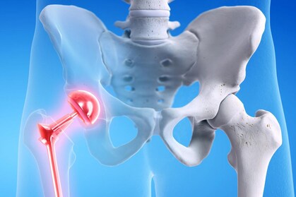 What Are the Risks of Hip Replacement Surgery?