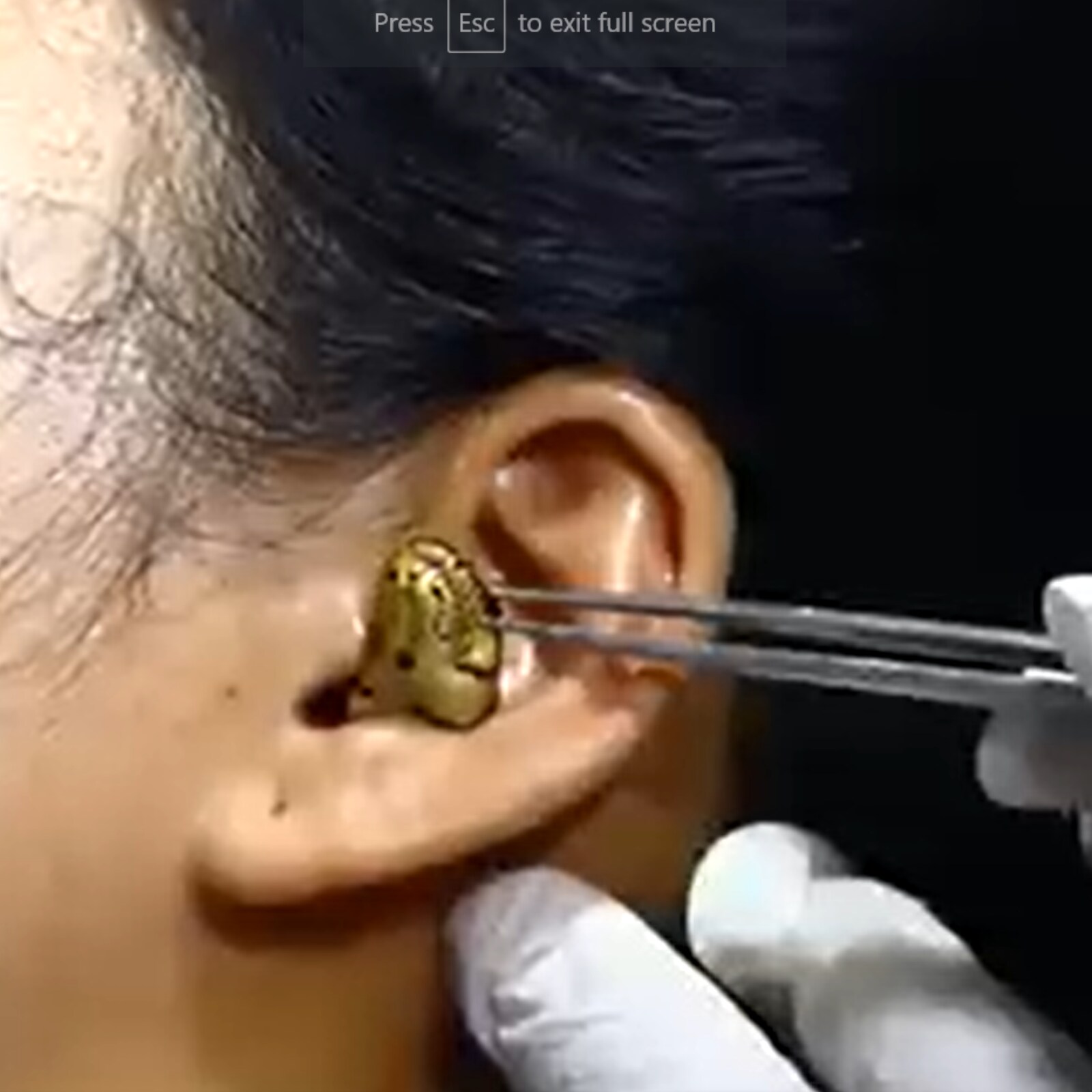 Update more than 69 earring stuck inside ear super hot esthdonghoadian