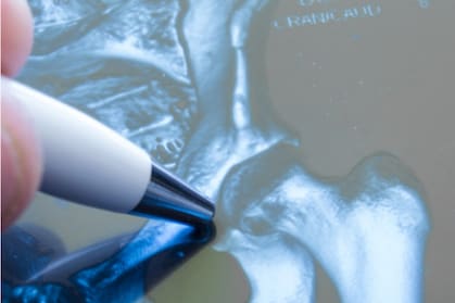 Hip Pain Relief - Surgical Treatment Options