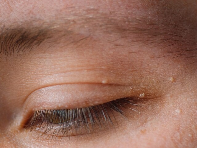 Cure and Causes of Milia, the Little White Bumps on Ones Face - News18