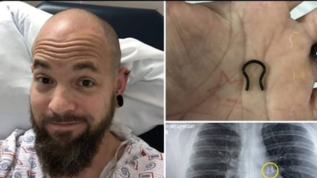 Man Finds Lost Nose Piercing After 5 Years. It Was Stuck In His Lungs