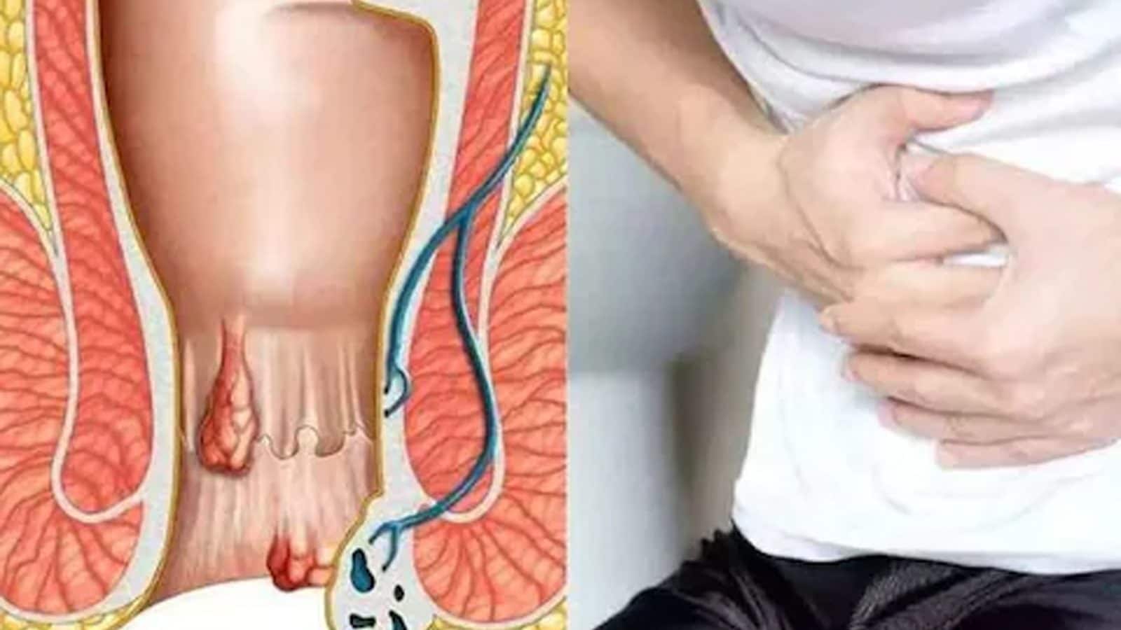 Delaying Treatment Of Fistula Could Be Fatal, Check Details