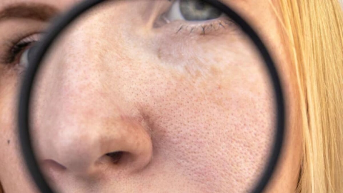 Ice Cubes To Multani Mitti, 5 Natural Remedies To Say Goodbye To Your Open Pores News18