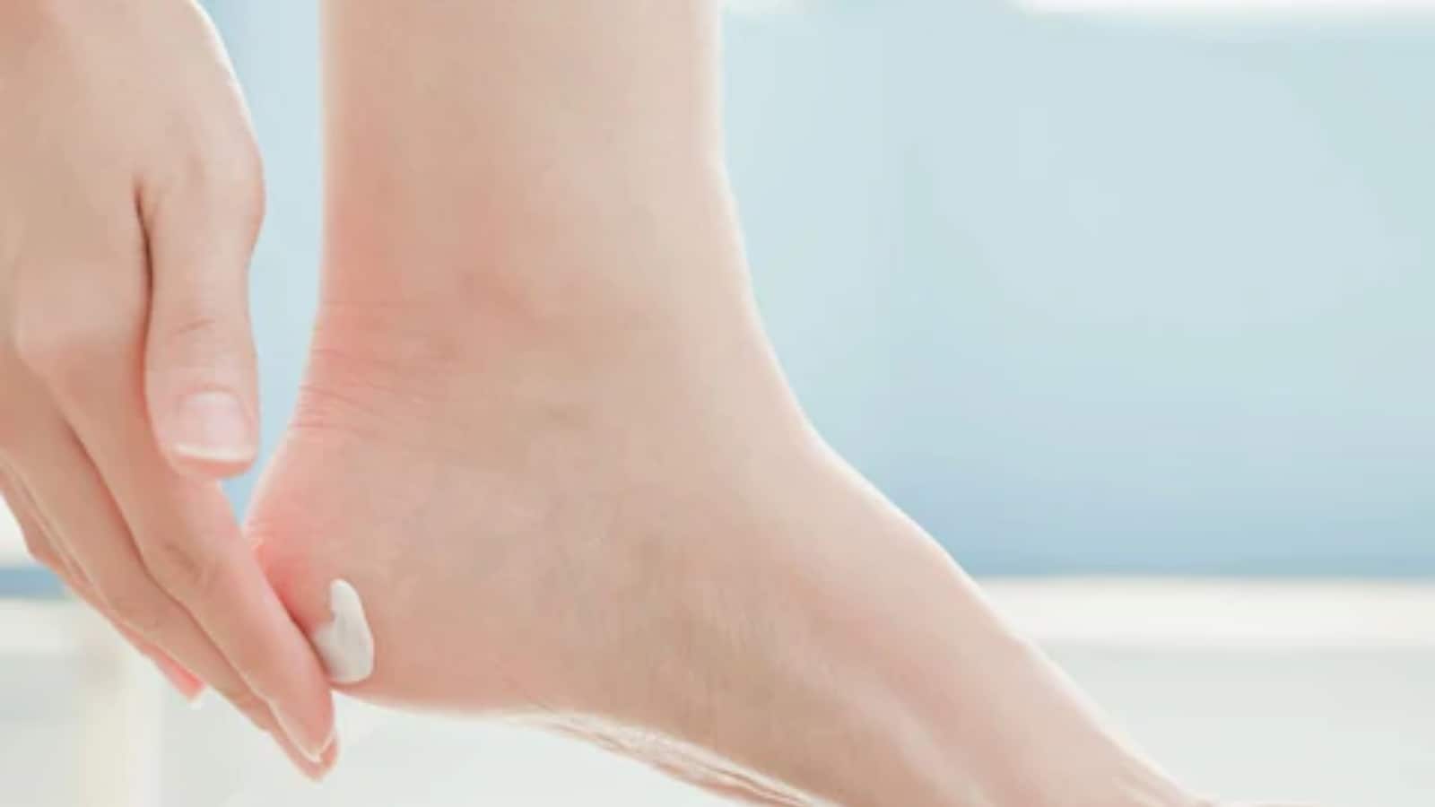 12 Simple Home Remedies for Cracked Heels