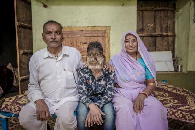 Lalit Patidar, a 17-year-old resident of Nandleta village, has hypertrichosis, which is characterised by excessive hair growth on any part of the body