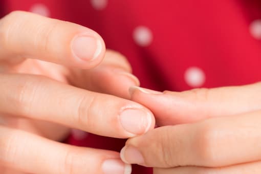 Koilonychia, or brittle fingernails, is a significant indicator of iron insufficiency. (Image: Shutterstock)