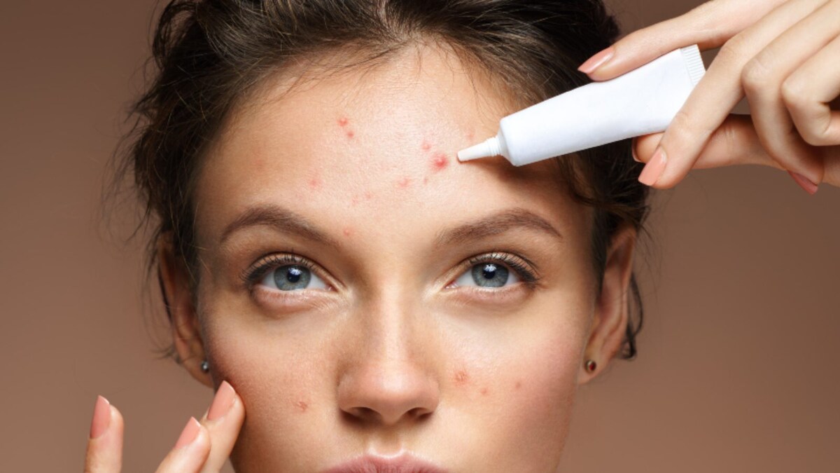 High-Risk Cosmetic Ingredients That Can Trigger Severe Acne