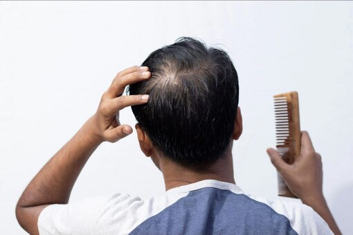 All You Need to Know About Hair Loss Causes, Prevention and Treatment All You Need to Know About Hair Loss Causes, Prevention and Treatment