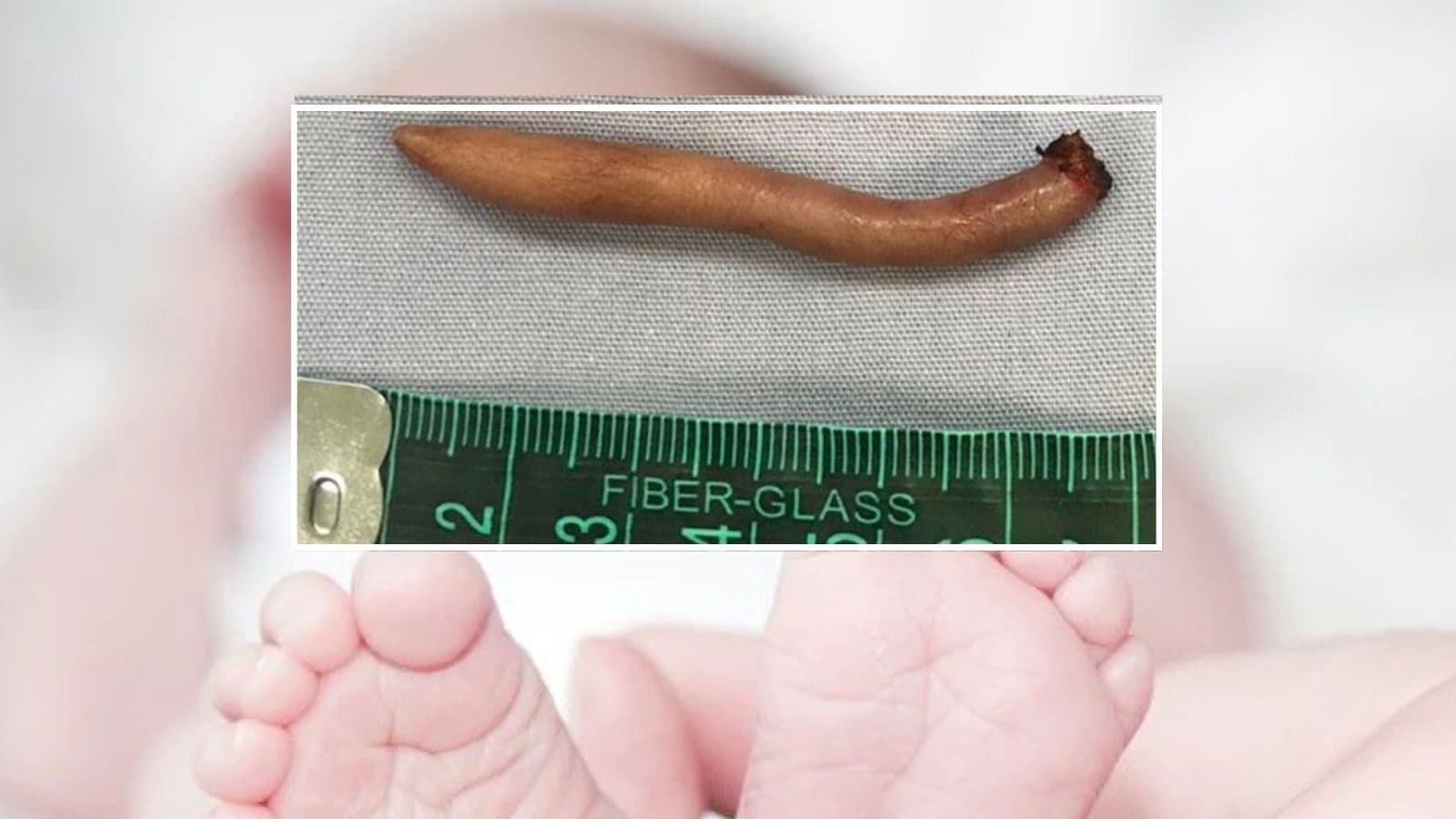 Baby Girl Born With Rare 2-Inch Long ‘True Tail’ in Mexico | Buzz News ...