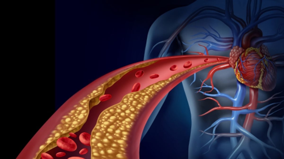 Good Cholesterol May Be A Risk Factor For Cardiovascular Disease: Study