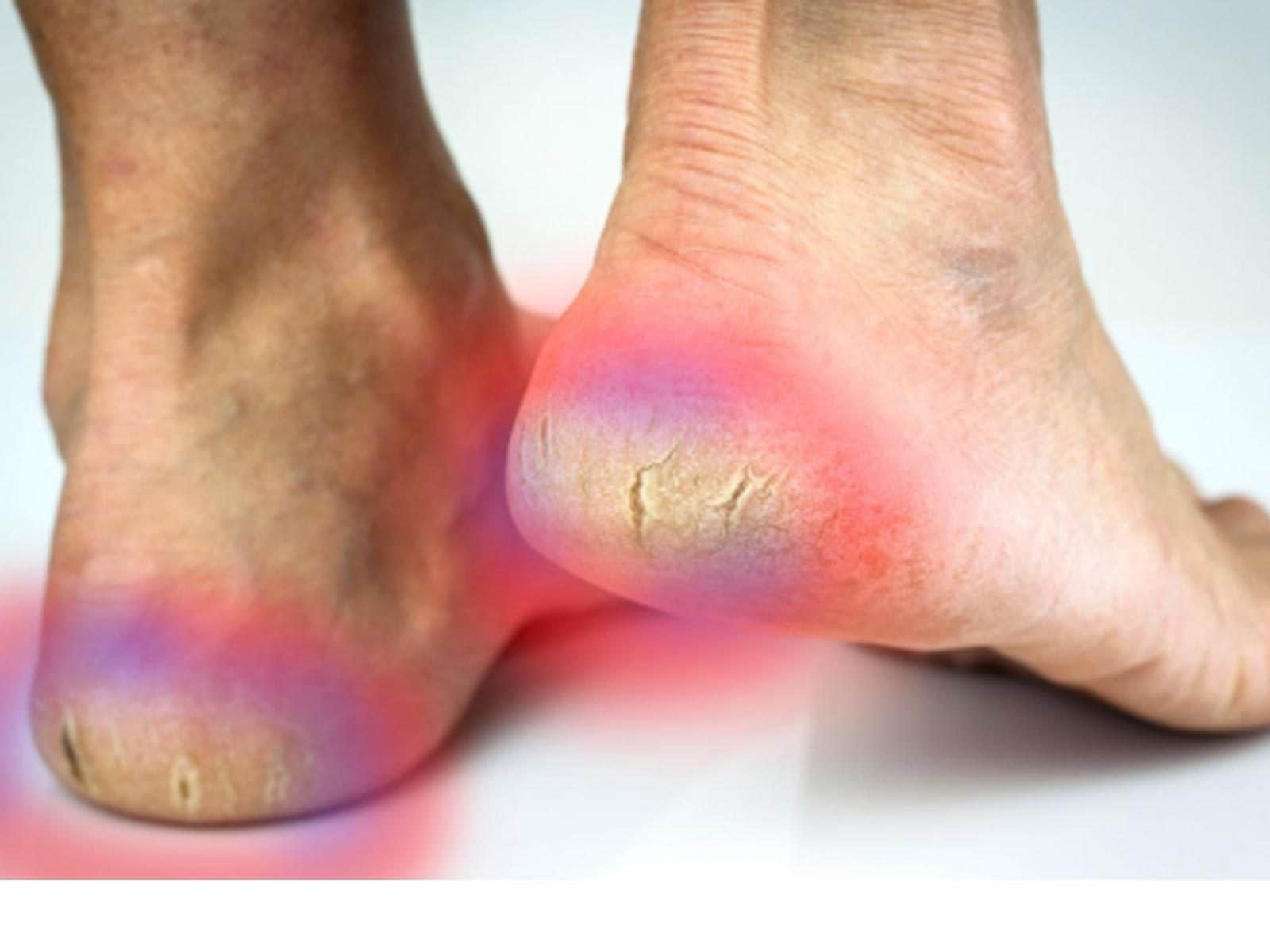 Cracked Heels and Heel Fissures | Causes and treatment options |  MyFootShop.com