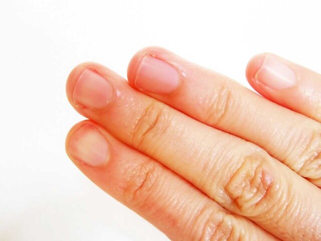 Are Your Fingertips Peeling? Know Home Remedies To Treat It - News18