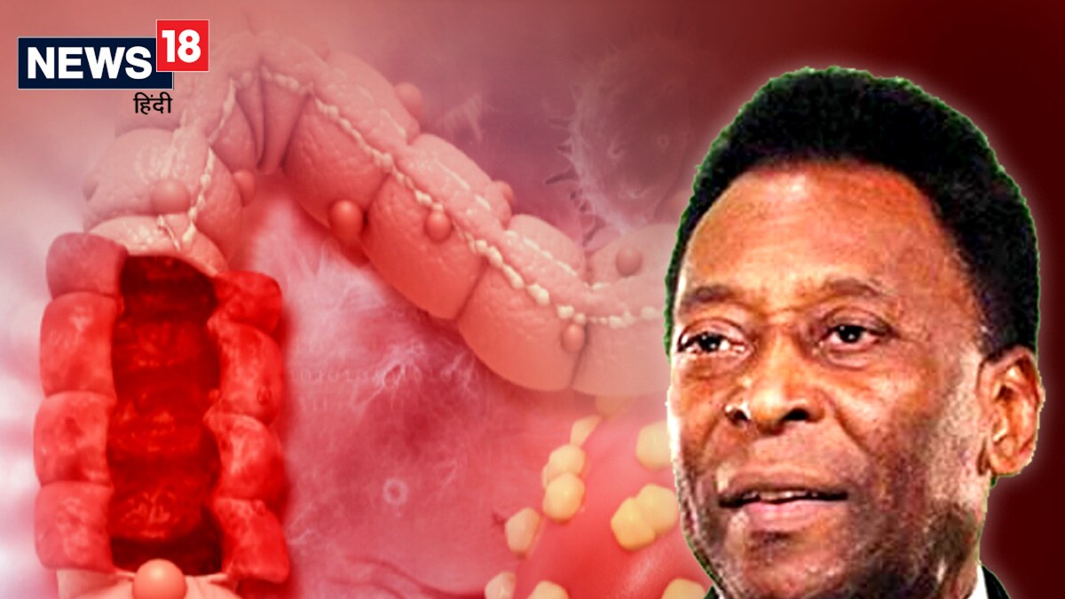 What is Colon Cancer, The One Football Legend Pele is Suffering From?