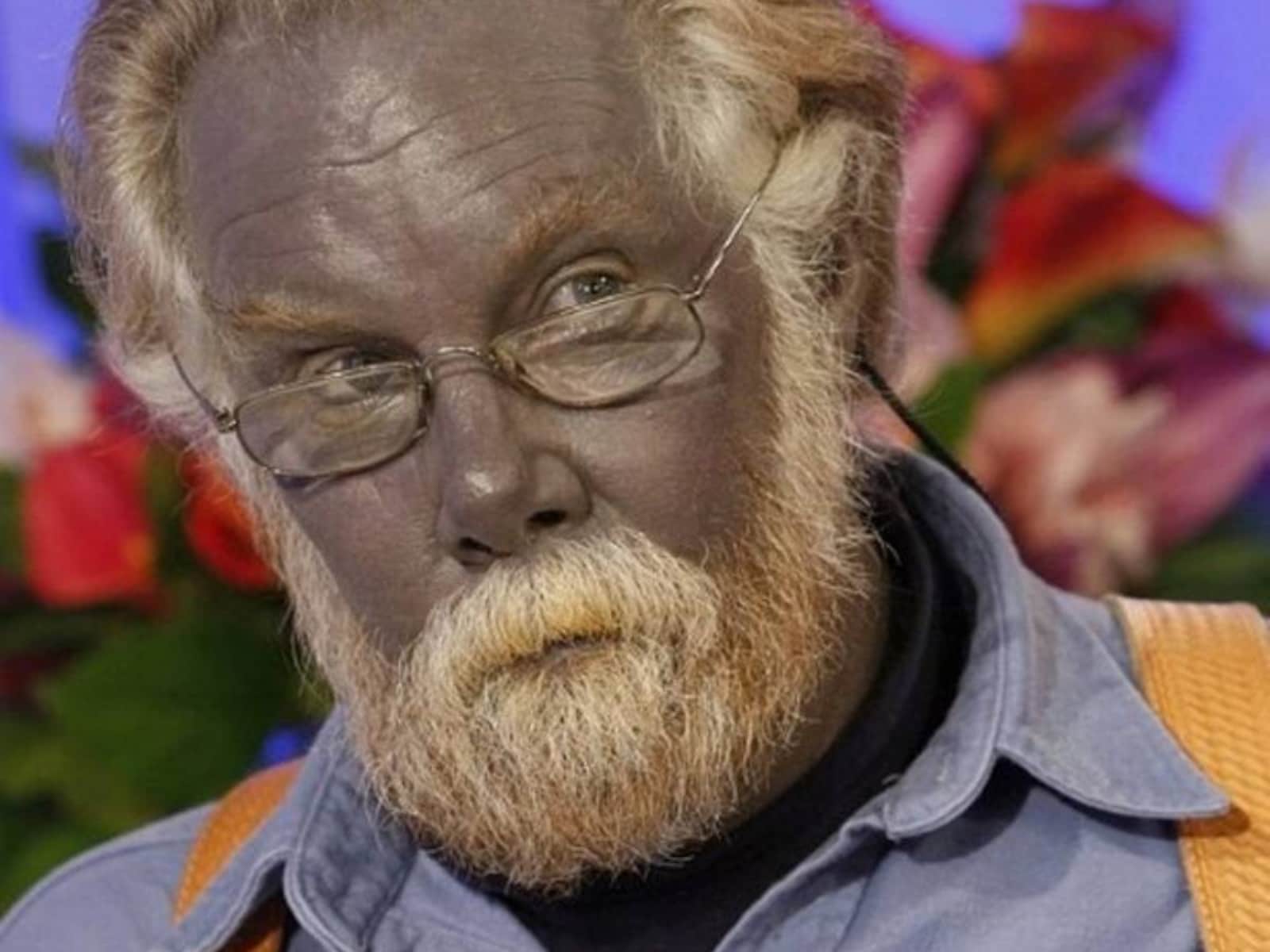 What is argyria, a condition that turns skin colour to blue?