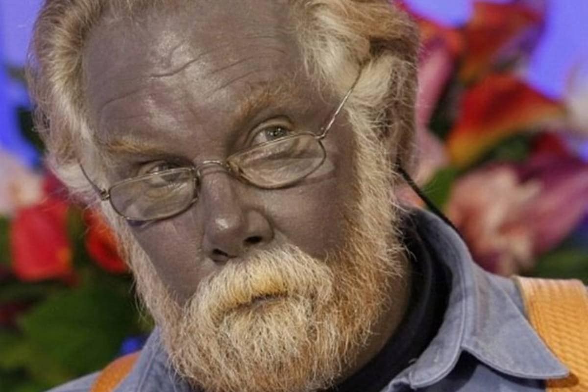 Meet 'Papa Smurf', The Man Whose Skin Turned Blue After Consuming Dietary  Supplements - News18