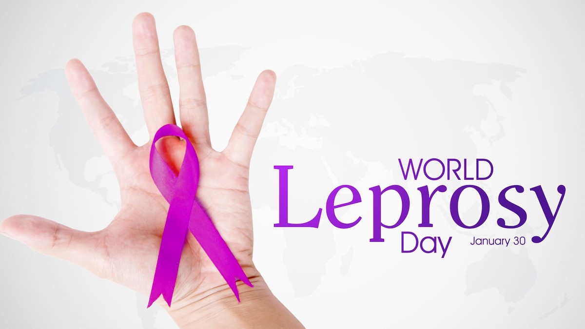 World Leprosy Day: Know More About The Condition, Symptoms, Causes And Treatment