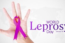 World Leprosy Day: Know More About The Condition, Symptoms, Causes And Treatment