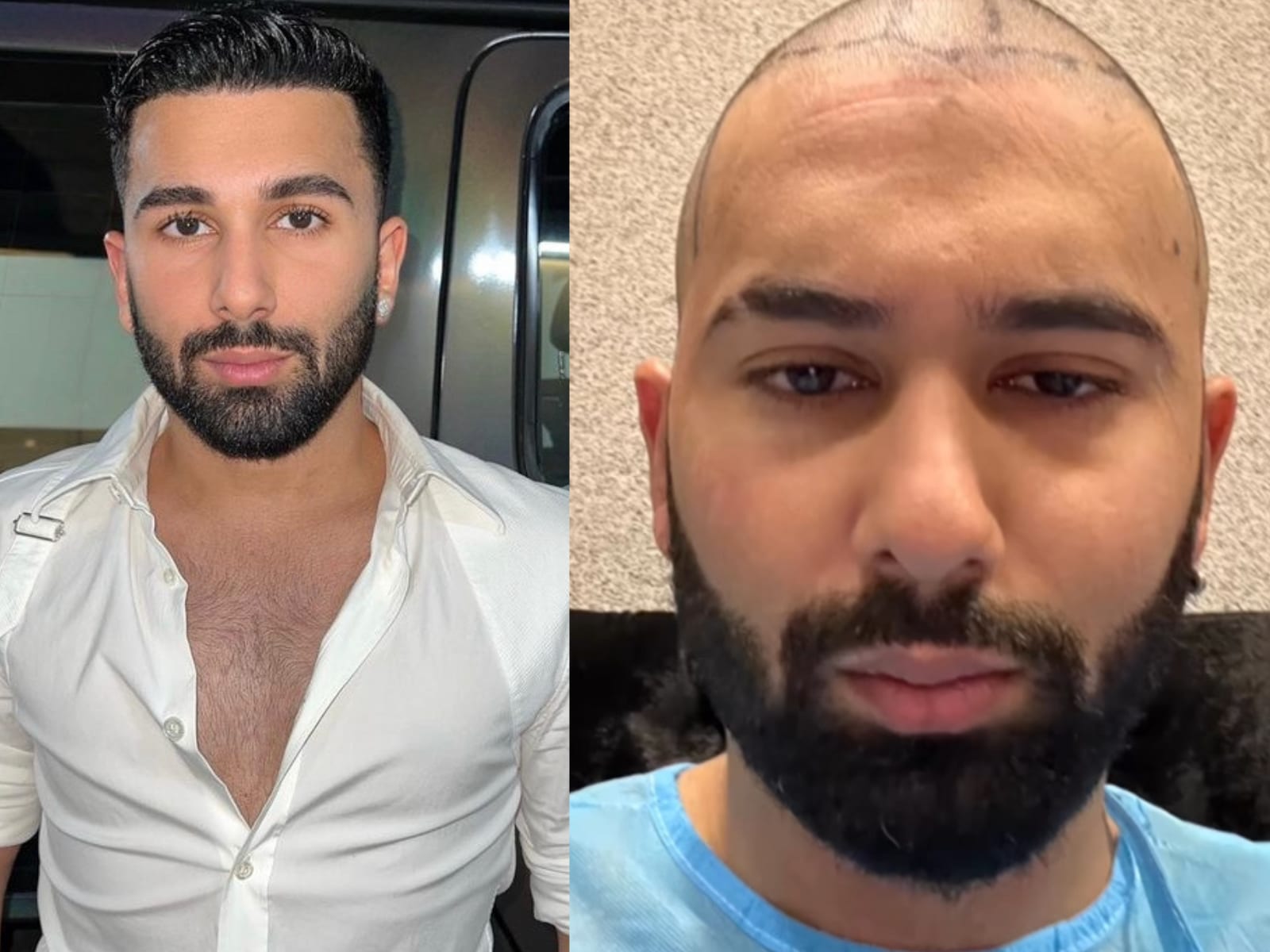 Cricketers Hair Transplantation  akruti