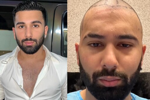 Orhan recently shared a video of the procedure along with glimpses of his journey to a thicker head of hair on Instagram. (Images: Instagram)