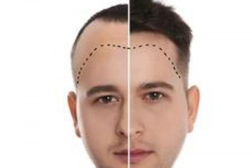 A hair transplant might be an artificial method of growing hair but it is not magic. (Image: Shutterstock)